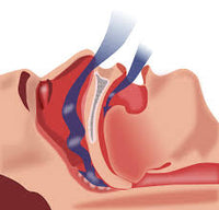 Sleep Apnea